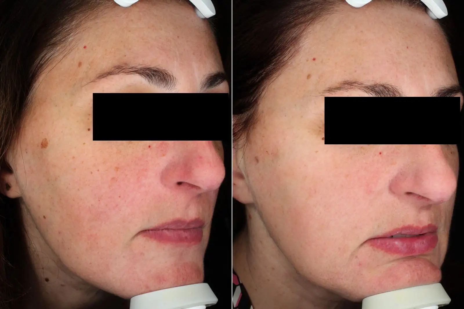 IPL 535 SMT, 1 SESSION