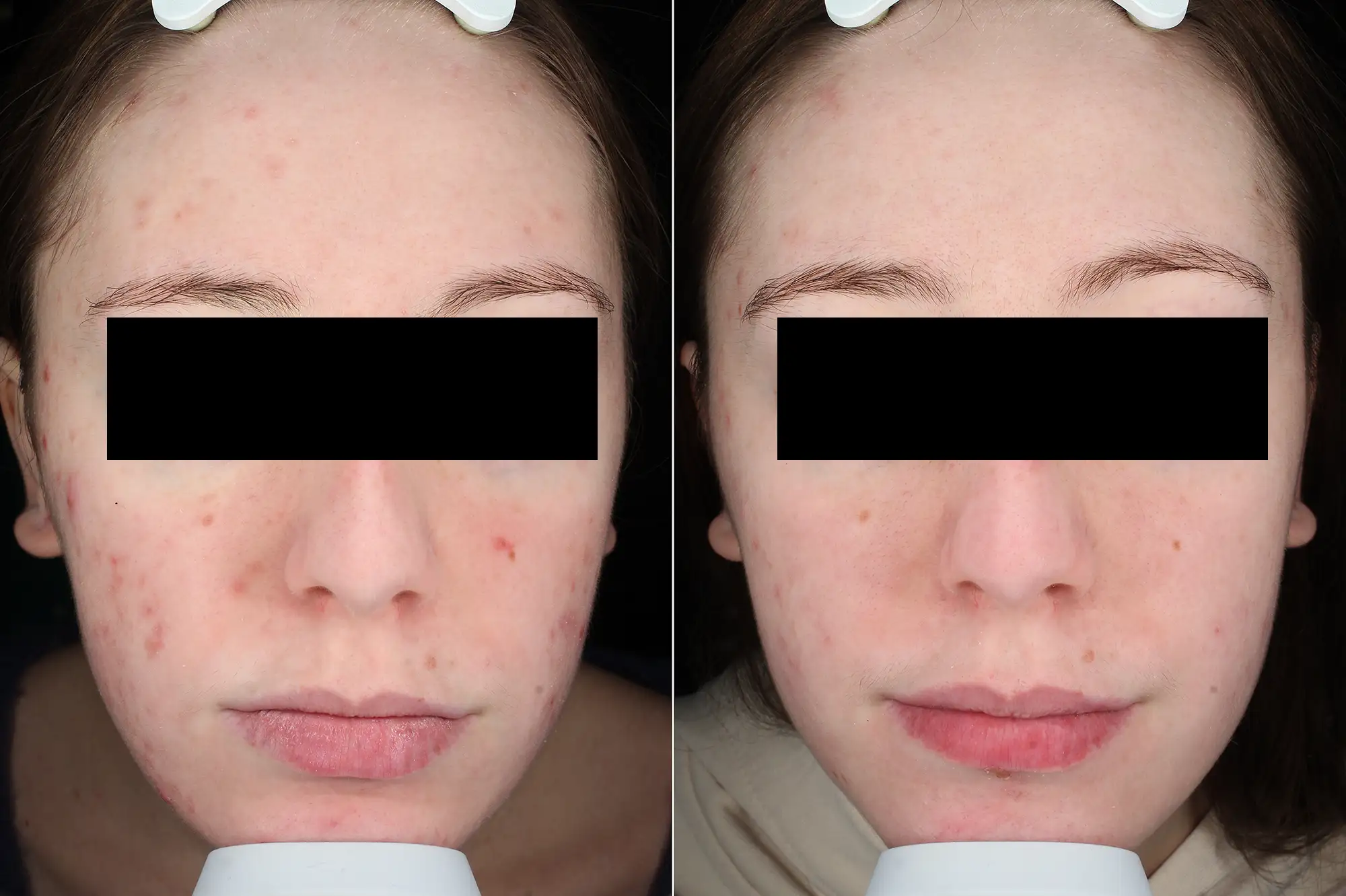 ACNE, IPL AC415
