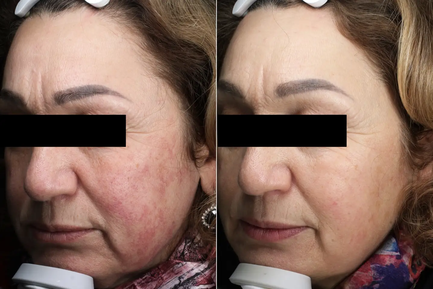 LATO SIN - IPL 535 SMT