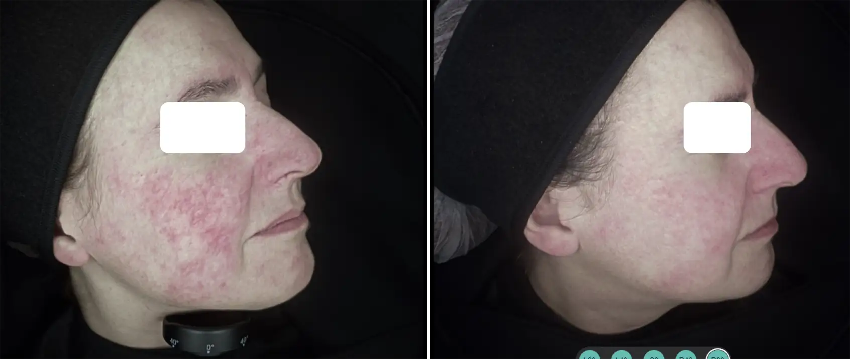 COMBINED PROTOCOL: IPL 535 SMT AND LASER 1064 LP