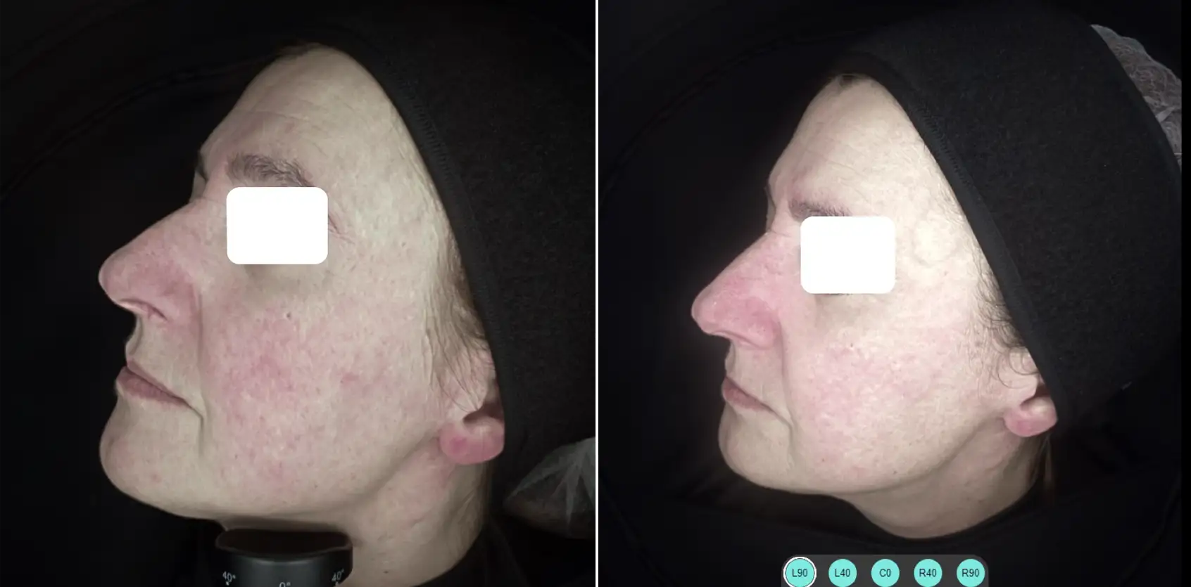 COMBINED PROTOCOL: IPL 535 SMT AND LASER 1064 LP