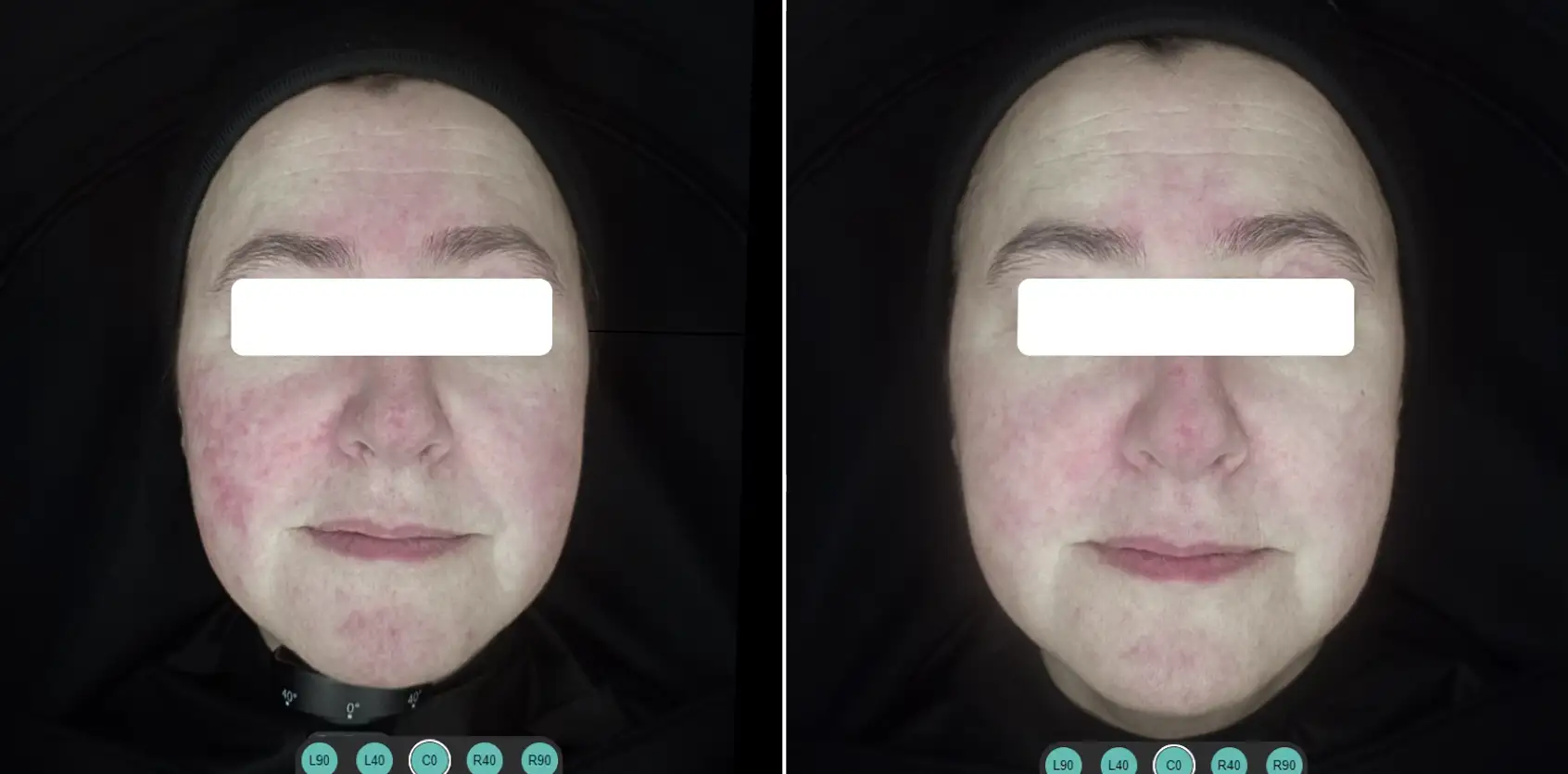 COMBINED PROTOCOL: IPL 535 SMT AND LASER 1064 LP